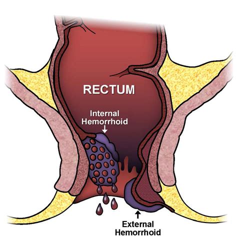 Bleeding Per Rectum Treatment In Jaipur