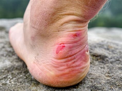 Details More Than 143 Blisters On Feet From Heels Best Vn