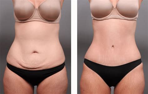 The Recovery Process After Tummy Tuck 2024