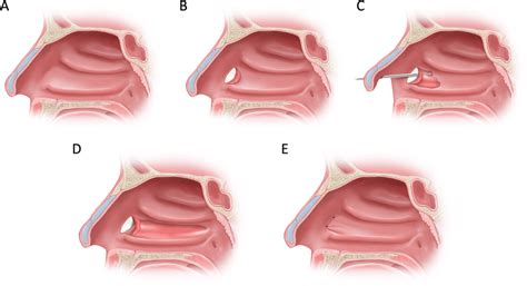 Diagram Of The Operative Procedure A A Right Nasal Cavity Is Seen