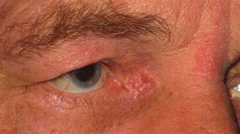 Eyelid Skin Cancers Eyelid Bcc Mr David Cheung Eyelid Specialist