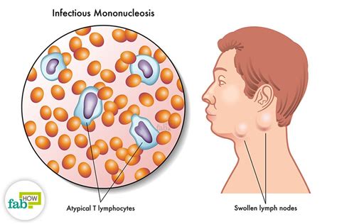 How To Treat Mononucleosis With Simple Home Remedies Fab How