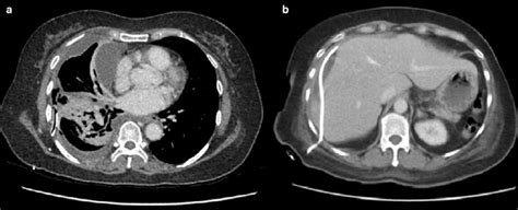 A Axial Ct Scan With Portal Venous Phase Contrast Of The Thorax