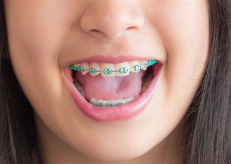 Kids Getting Braces In Singapore Read This Advice Honeykids Asia
