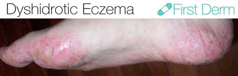 First Derm Dyshidrotic Eczema Dyshidrosis