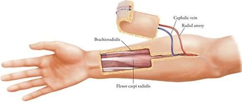 Radial Forearm Free Flap Morita Et Al Download Scientific Diagram