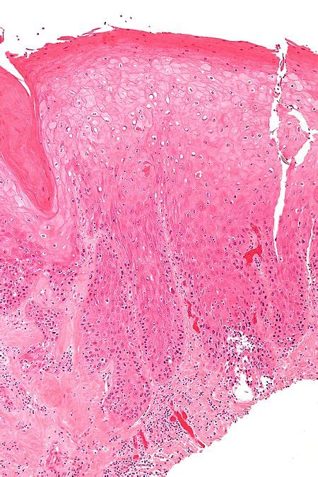 Differentiated Vulvar Intraepithelial Neoplasia Libre Pathology