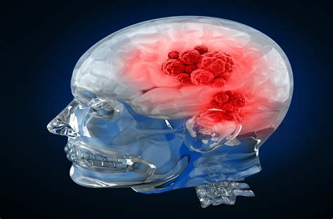 What Is Brain Tumor Everything You Need To Know About
