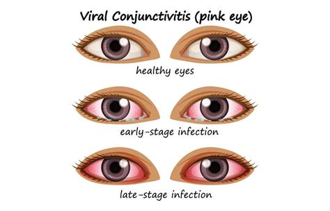 Understanding Conjunctivitis Causes Symptoms And Prevention Techs