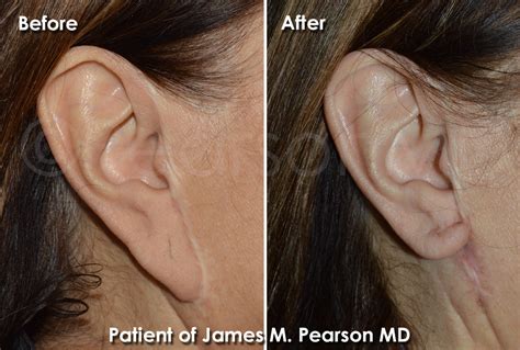 Pixie Ear Lobe Repair Photos Dr James Pearson Facial Plastic Surgery