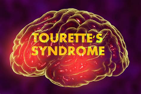 Tourettes Syndrome And Tics Disorders Brainx Brain And Mind Centres