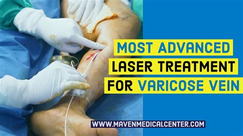 Varicose Veins Most Advance Laser Treatment Youtube