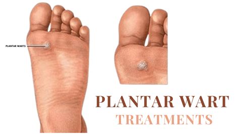 plantar wart treatments comprehensive guide to effective remedies