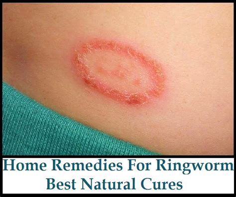 Home Remedies For Ringworm Best Natural Cures Skinnyzine
