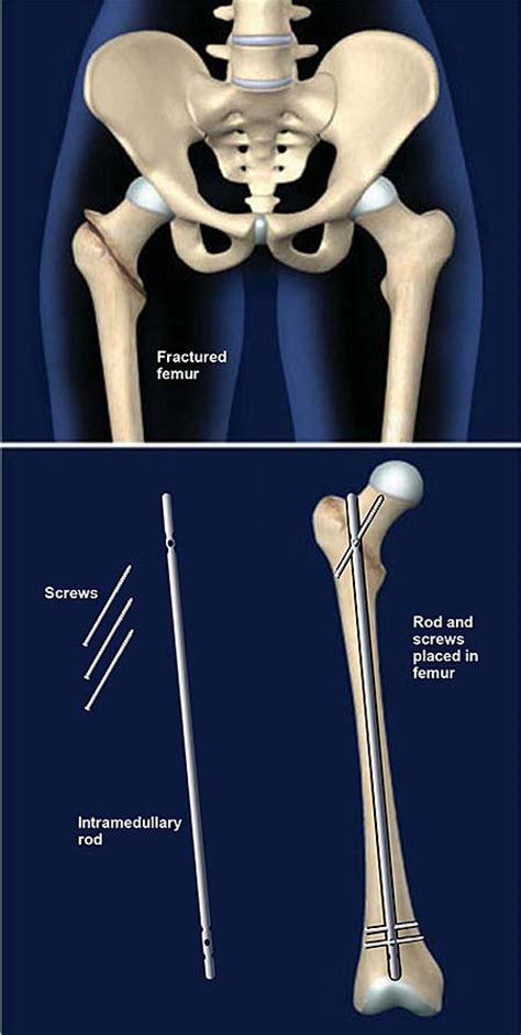Femur Fracture Fixation With Intramedullary Rod Central Coast Orthopedic Medical Group