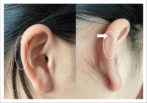 Posterior Helicine Type Of Preauricular Fistua A Small Pit White