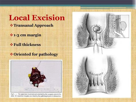 Ppt Rectal Cancer Powerpoint Presentation Free Download Id2276176