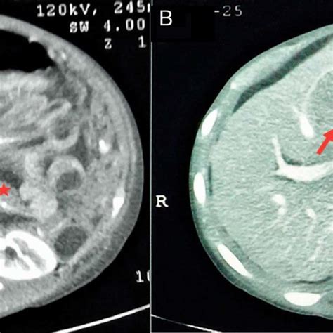 Abdominal Computed Tomography Scan Showing A Soft Tissue Thickening