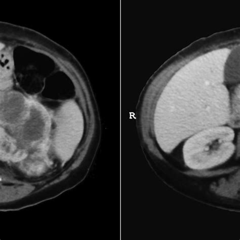 Axial Computed Tomography Of The Abdomen After Intravenous Contrast