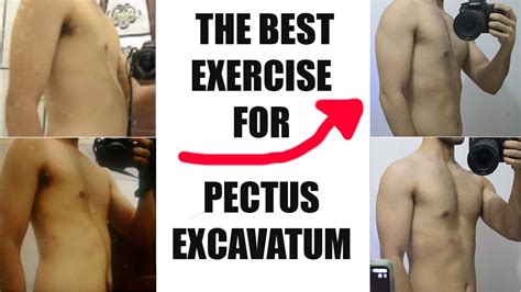 The Best Exercise For Pectus Excavatum YouTube