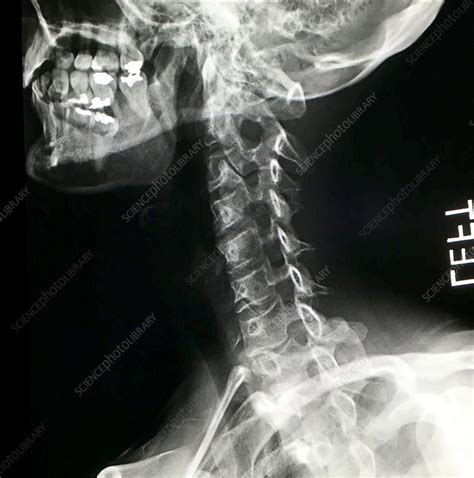 Normal Cervical Spine X Ray Stock Image C0393919 Science Photo