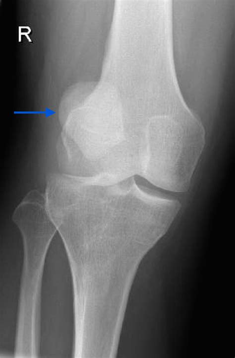 Cureus Magnetic Resonance Imaging Features Of Traumatic