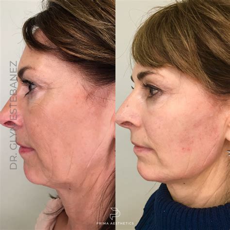 Full Face Rejuvenation Treatment In Chester Dr Glyn Estebanez