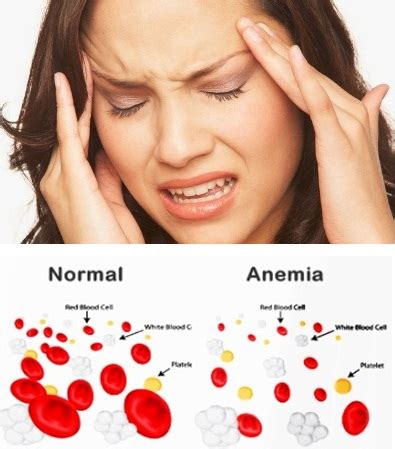 Anemia adalah kondisi di mana tubuh tidak mempunyai cukup butir darah merah atau kekurangan kadar hemoglobin di dalam darah. Cara Mengobati Penyakit Anemia (Kurang Darah) Secara ...