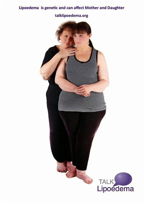 The Well Rounded Mama Lipedema Part 4 Possible Causes And Associated