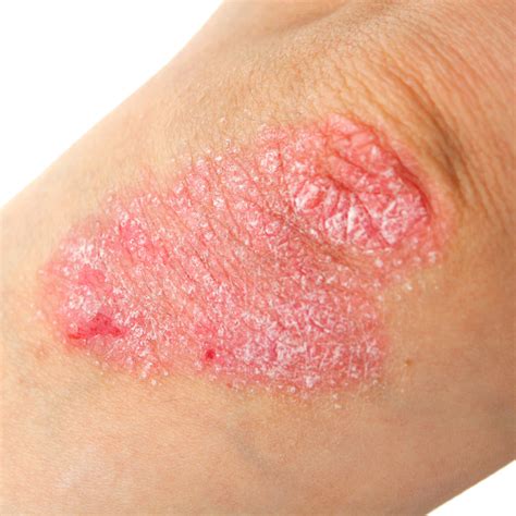 Eczema Flare Up Heres How To Keep Symptoms Under Control Terris