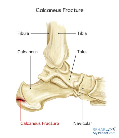 Calcaneus Liberal Dictionary