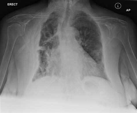 Mesothelioma X Ray Findings Ijerph Free Full Text Clinical