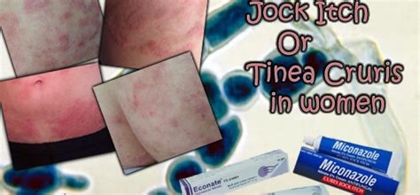 jock itch or tinea cruris in women causes and treatment wivesmag