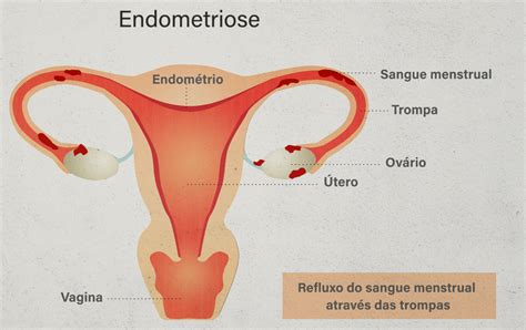 ˌɛndəʊˌmiːtriˈəʊsɪs n → endométriose f. Endometriose - Sintomas, Diagnóstico e Exames de Imagem