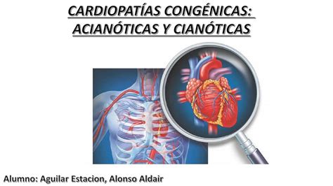 CardiopatÍas CongÉnitas Enfermedades Salud Udocz