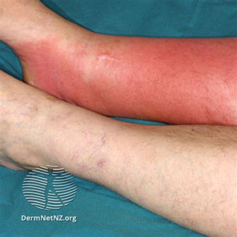 Cellulitis Clinical Presentation Differential Diagnosis And Treatment