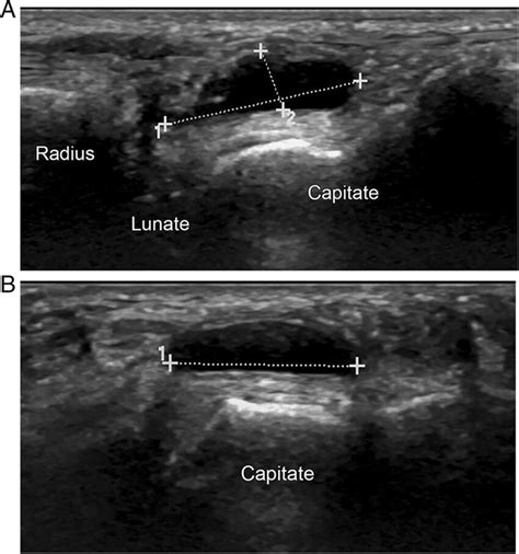 Dorsal Ganglion Cyst Ultrasound Images Of Dorsal Wrist In A Sagittal Sexiz Pix