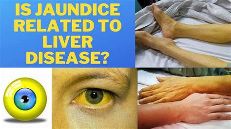 Is Jaundice Related To Liver Disease What Abnormal Liver Events