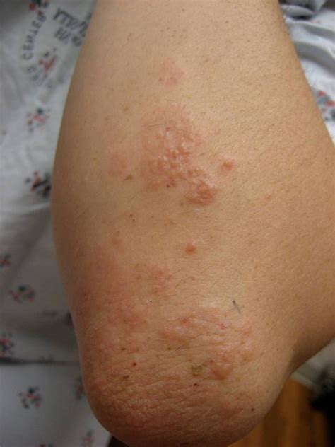 Dermatitis Herpetiformis Duhring Disease Dermatology Advisor