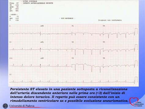 La pericardite acuta si sviluppa rapidamente, causando infiammazione del sacco pericardico e spesso un'effusione pericardica. PPT - SOPRASLIVELLAMENTO DEL SEGMENTO ST PowerPoint ...