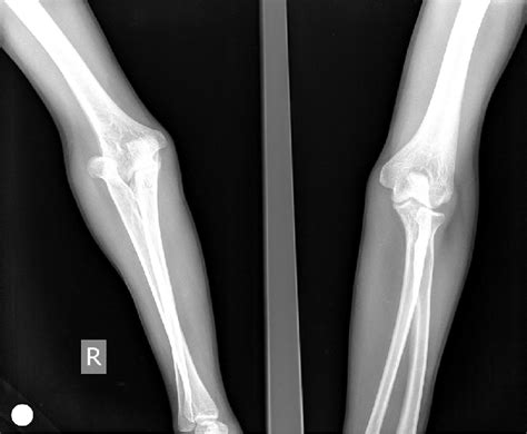 X Ray Of The Patient Showing Radial Head Dislocation Download
