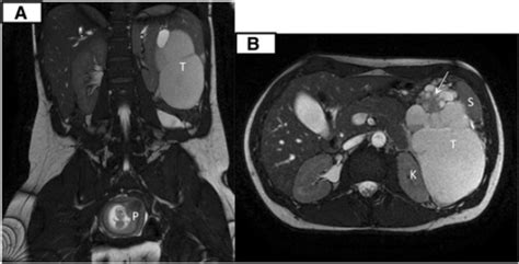 Coronal A And Transversal B Mri T2 Fiesta View L Open I