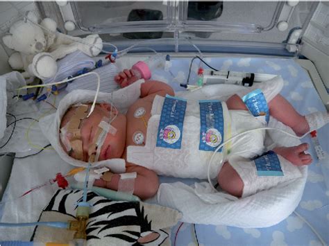 Figure 2 From Therapeutic Hypothermia In Neonatal Asphyxia Semantic