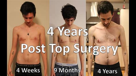 Ftm Transgender 4 Years Post Top Surgery Youtube