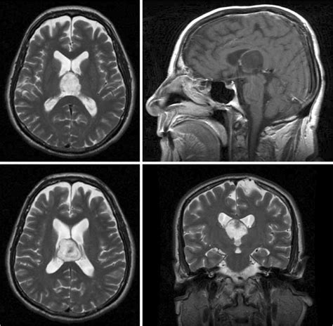 Lesion Of The Posterior Part Of The Third Ventricle Epidermoid Tumor