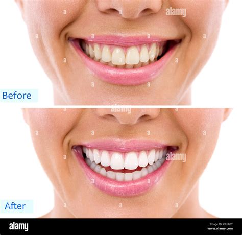 Whitening Bleaching Treatment Before And After Woman Teeth And