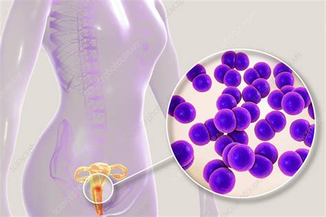 Gonorrhoea Infection In Female Illustration Stock Image F022 8306 Science Photo Library