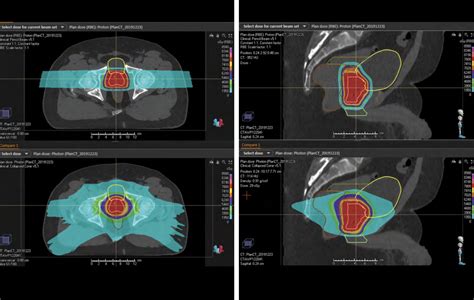 Proton Therapy Case Study Prostate Cancer BroadcastMed