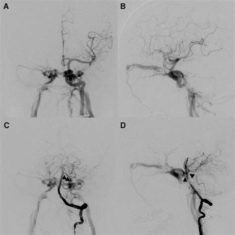 A And B Left Internal Carotid Angiography Reveals High Flow Shunt