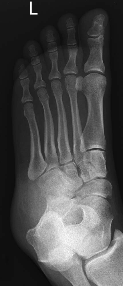 Nutcracker Fracture Of The Cuboid Wikiradiography